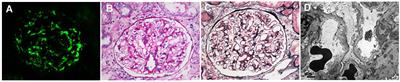 Characterization of patients with IgA nephropathy with and without associated minimal change disease